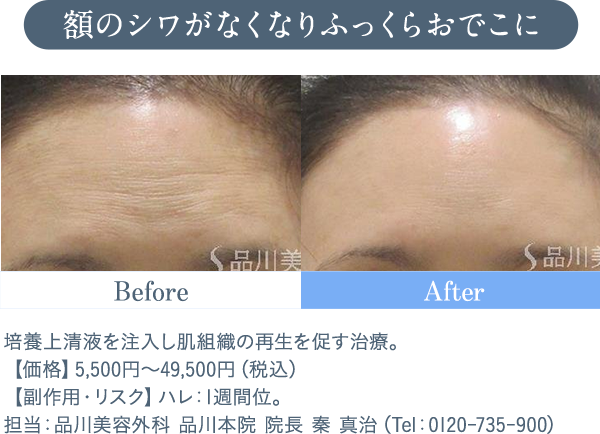 額のシワがなくなりふっくらおでこに 培養上清液を注入し肌組織の再生を促す治療。【価格】5,500円～49,500円（税込）　【副作用・リスク】ハレ：1週間位。担当：品川美容外科 品川本院 院長 秦 真治（Tel：0120-735-900）