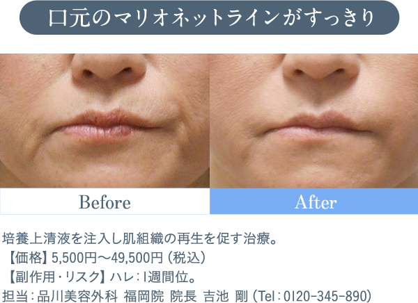 口元のマリオネットラインがすっきり 培養上清液を注入し肌組織の再生を促す治療。【価格】5,500円～49,500円（税込）　【副作用・リスク】ハレ：1週間位。担当：品川美容外科 福岡院 院長 吉池 剛（Tel：0120-345-890）