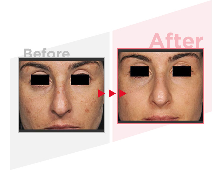 Before_After