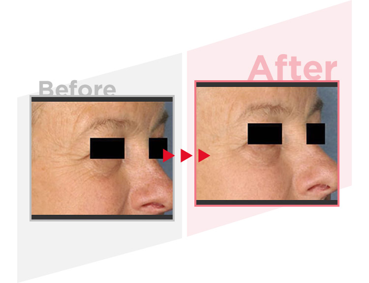 Before_After
