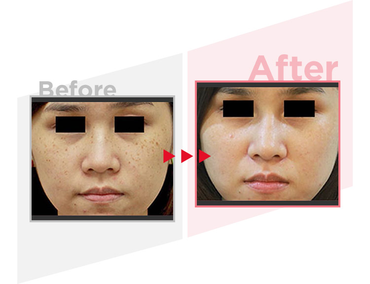 Before_After