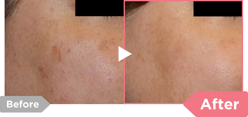 Before After