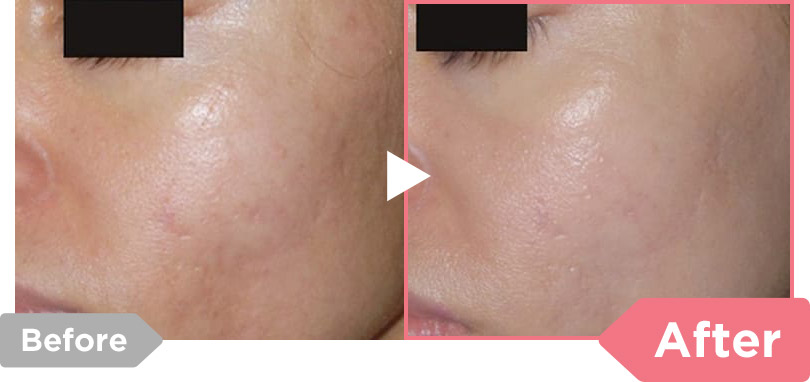 Before After