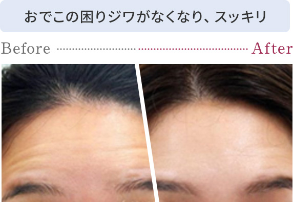 おでこの困りジワがなくなり、スッキリ