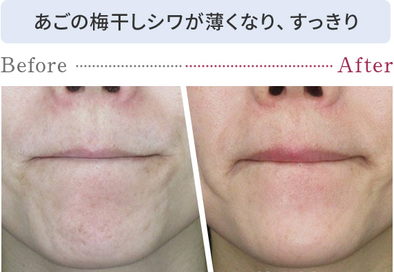 あごの梅干しシワが薄くなり、すっきり