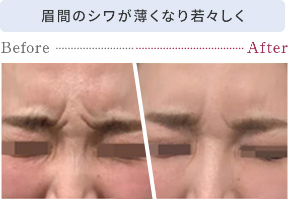 眉間のシワが薄くなり若々しく