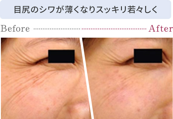 目尻のシワが薄くなりスッキリ若々しく
