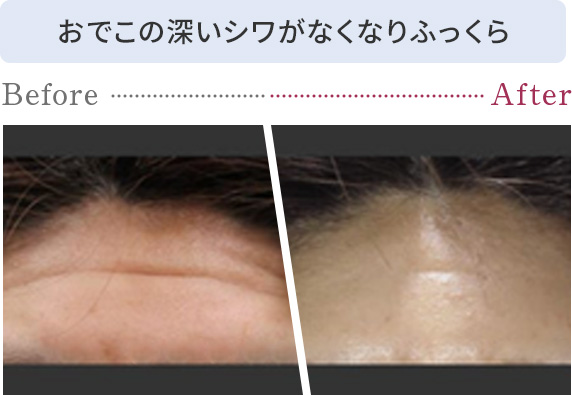 おでこの深いシワがなくなりふっくら