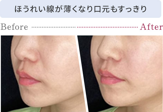 ほうれい線が薄くなり口元もすっきり