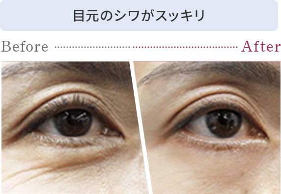 目元のシワがスッキリ