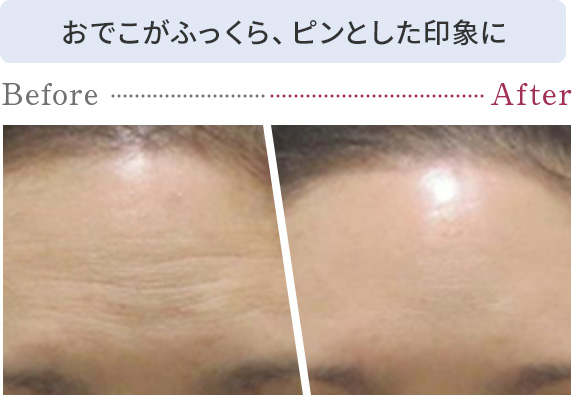 おでこがふっくら、ピンとした印象に