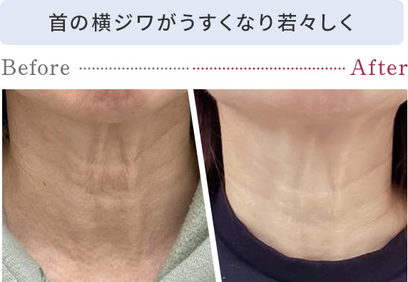 首の横ジワがうすくなり若々しく
