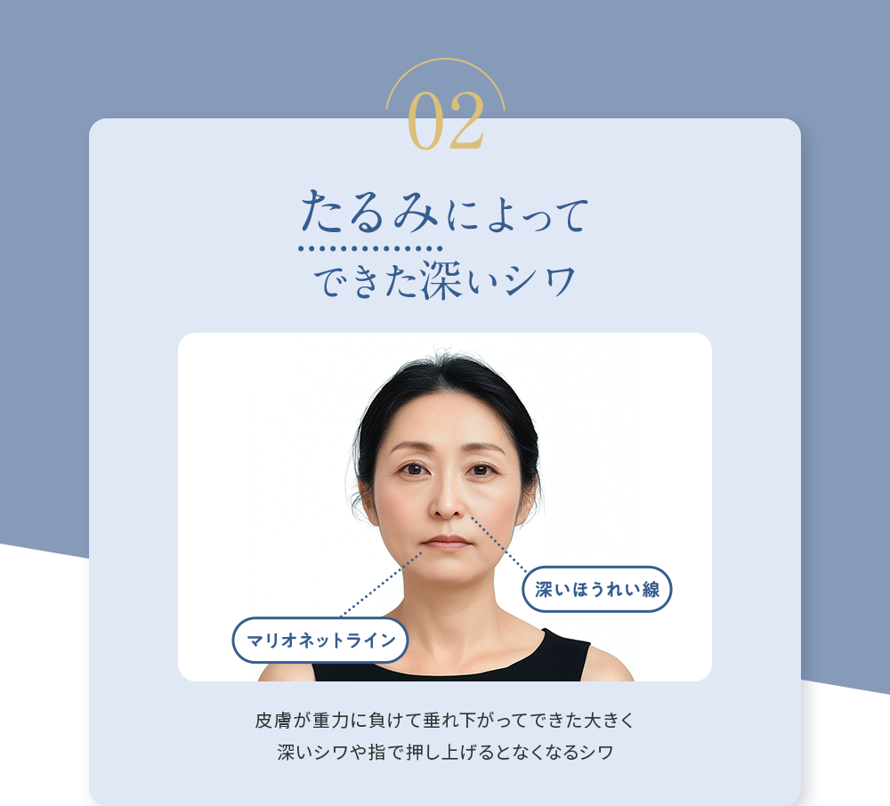 02 たるみによってできた深いシワ