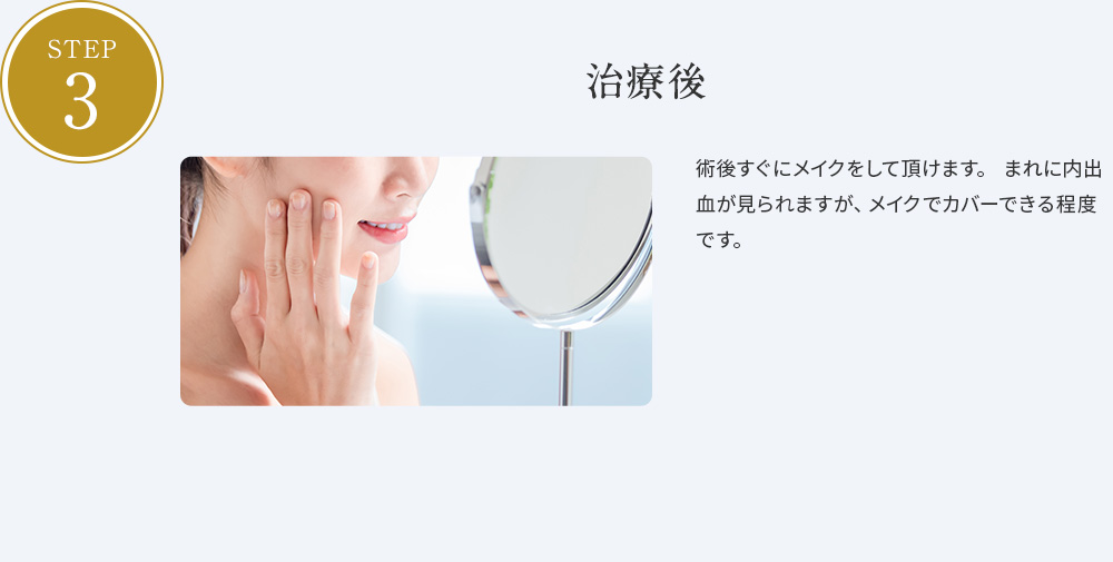 STEP03 施術後 術後すぐにメイクをして頂けます。 まれに内出血が見られますが、メイクでカバーできる程度です。
