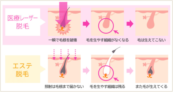 医療レーザー脱毛　一瞬で毛根を破壊→毛を生やす組織が無くなる→毛は生えてこない