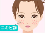 ニキビ跡を消したい！