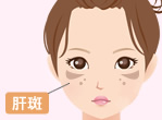 肝斑・色素沈着が気になる！