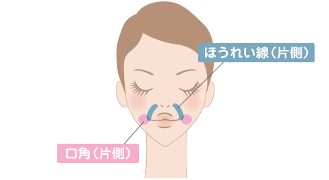 注射によるシワ取り治療＜ほうれい線/口角＞　対象部位