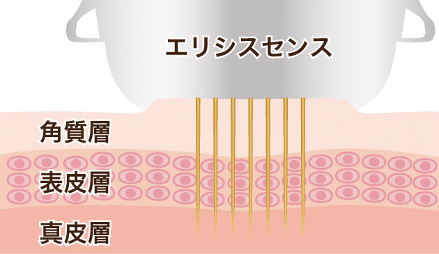 熱（高周波）を真皮層へ