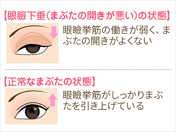 眼瞼下垂の説明図