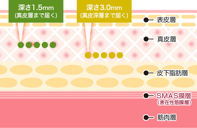 3Dハイフの肌イメージ図