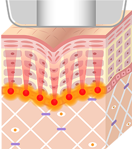 HIFUエネルギーを照射