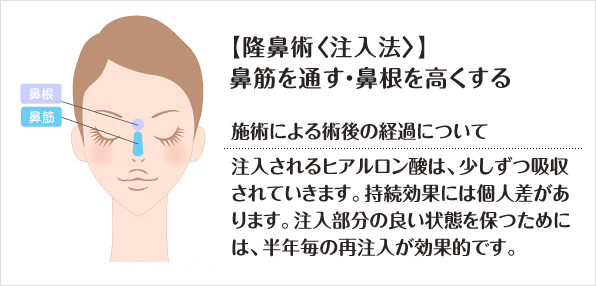 【隆鼻術〈注入法〉】鼻筋を通す・鼻根を高くする 施術による術後の経過について注入されるヒアルロン酸は、少しずつ吸収されていきます。持続効果には個人差があります。注入部分の良い状態を保つためには、半年毎の再注入が効果的です。