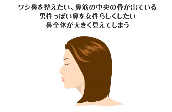 ワシ鼻を整えたい、鼻筋の中央の骨が出ている 男性っぽい鼻を女性らしくしたい 鼻全体が大きく見えてしまう