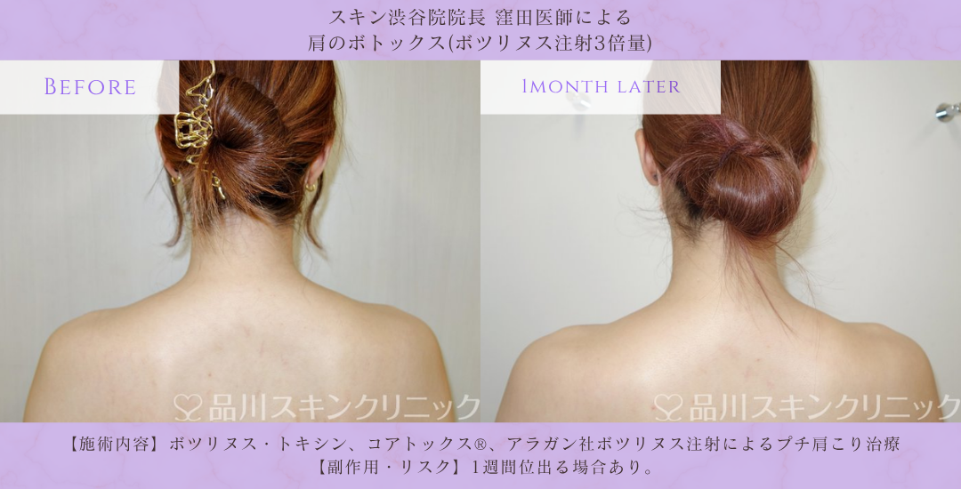 肩ボトックス モニター 症例写真