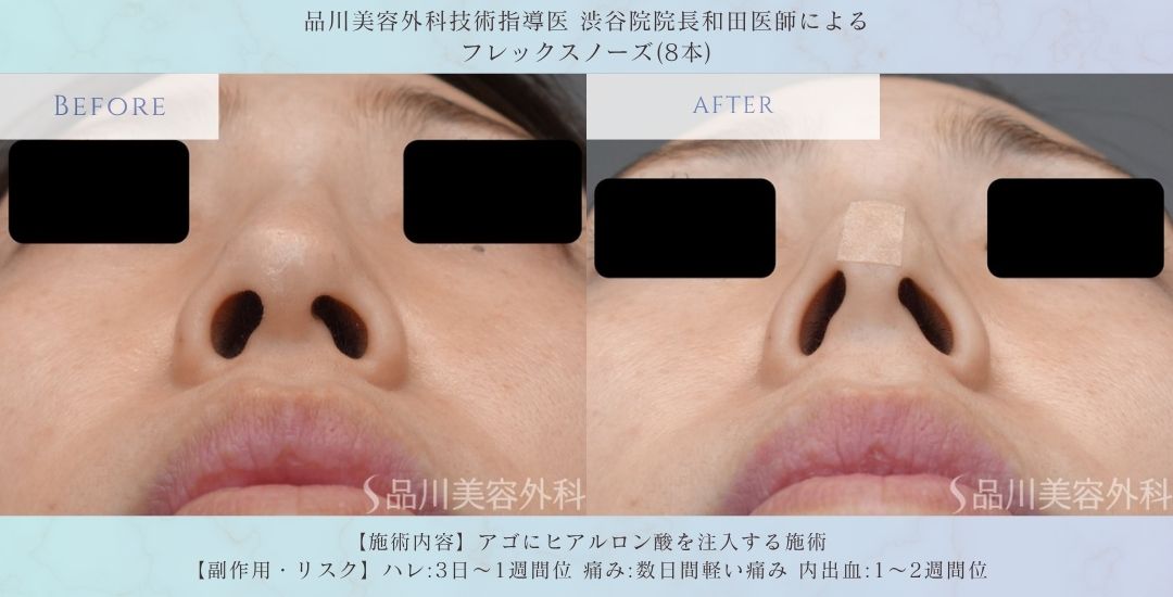 alt="フレックスノーズ 術前術後 比較 症例"