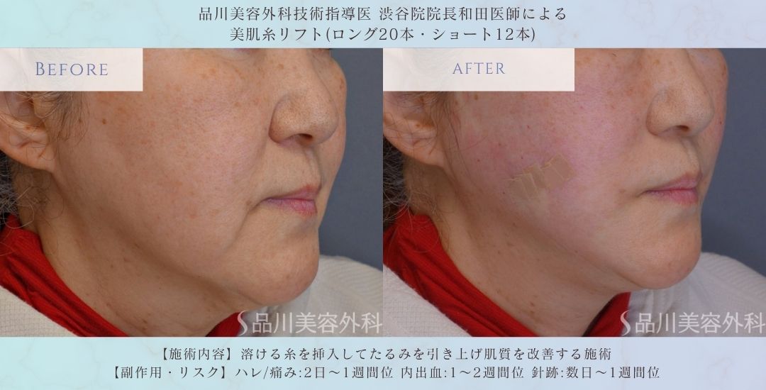 美肌糸リフト 小顔 症例