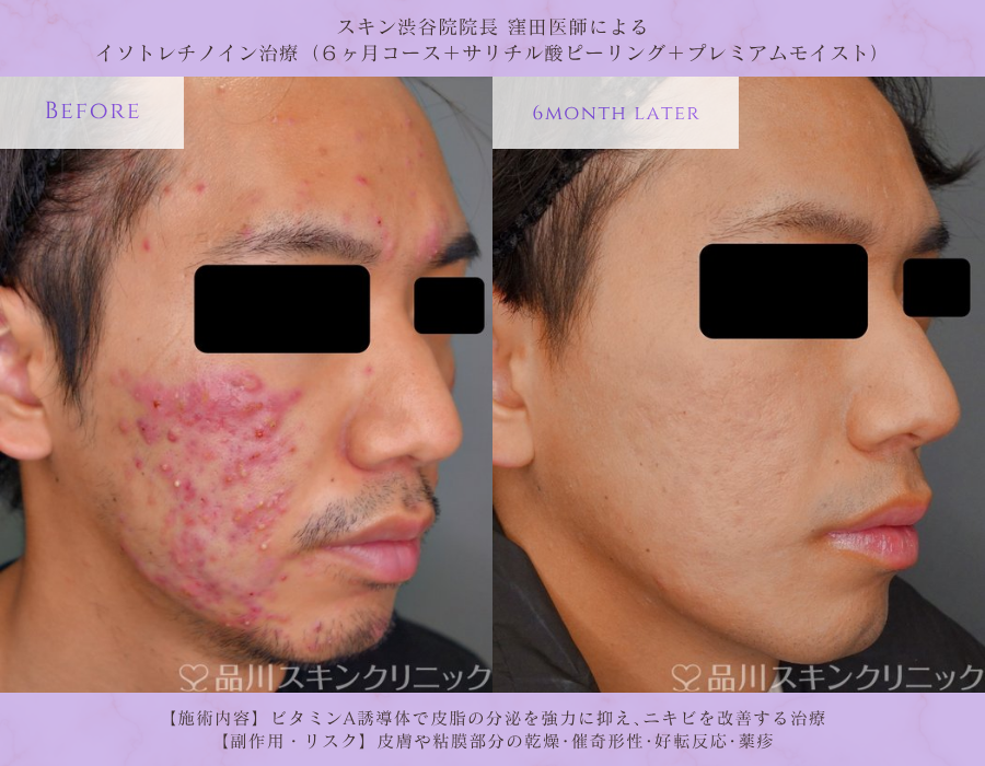 イソトレチノイン ニキビ改善 症例