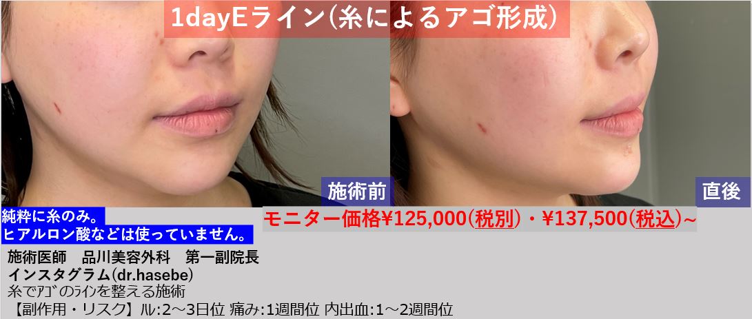 渋谷院 長谷部 智久医師による1day Eライン 137 500 品川美容外科症例モニター募集 全国版