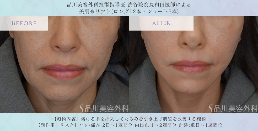 美肌糸リフト 術前術後 比較 症例