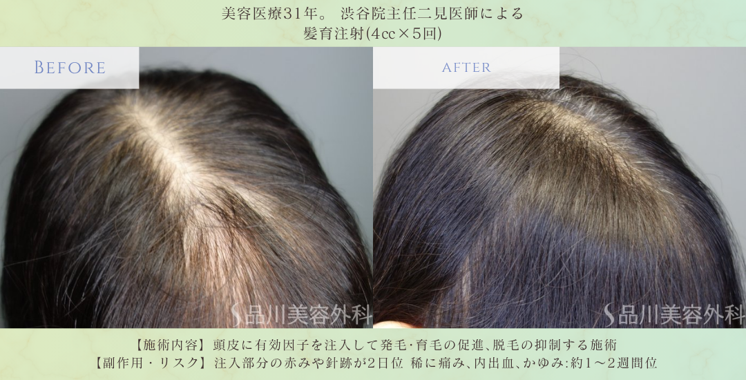 髪育注射 分け目改善 症例