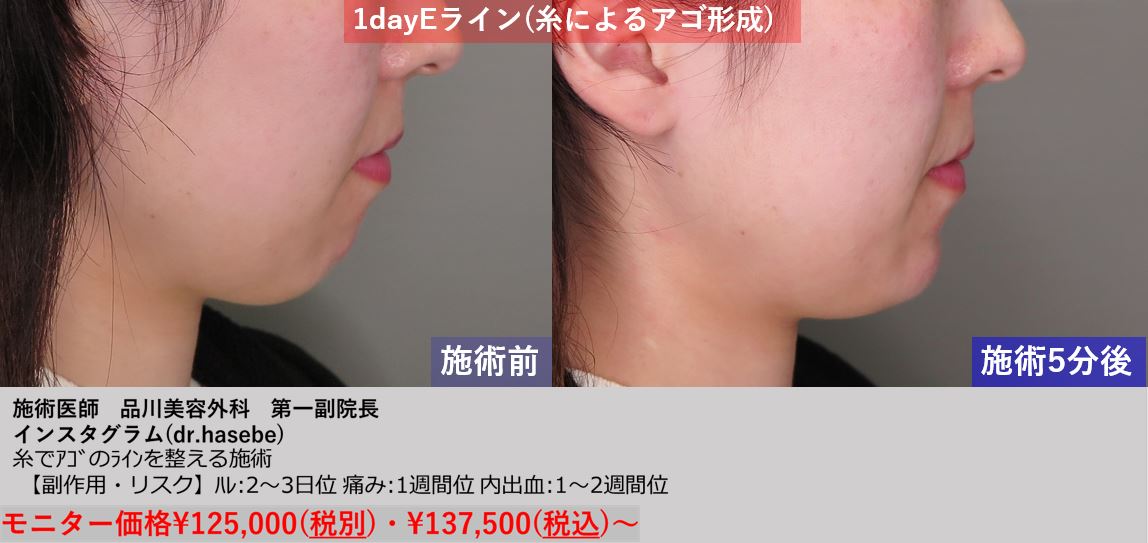 渋谷院 長谷部 智久医師による1day Eライン 137 500 品川美容外科症例モニター募集 全国版