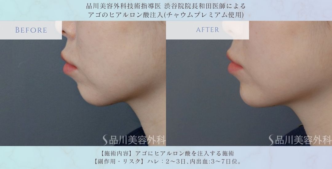 alt="アゴをシャープに見せる ヒアルロン酸 症例"