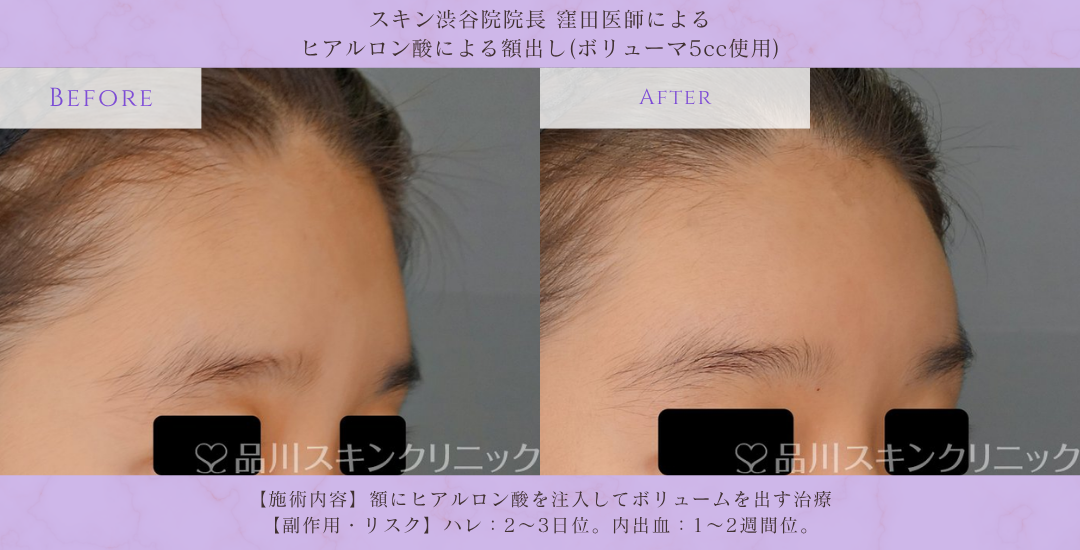 額ヒアルロン酸 立体感形成 症例