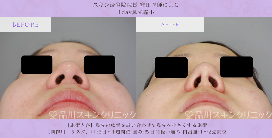 1day鼻先縮小 症例写真 品川スキンクリニック渋谷院