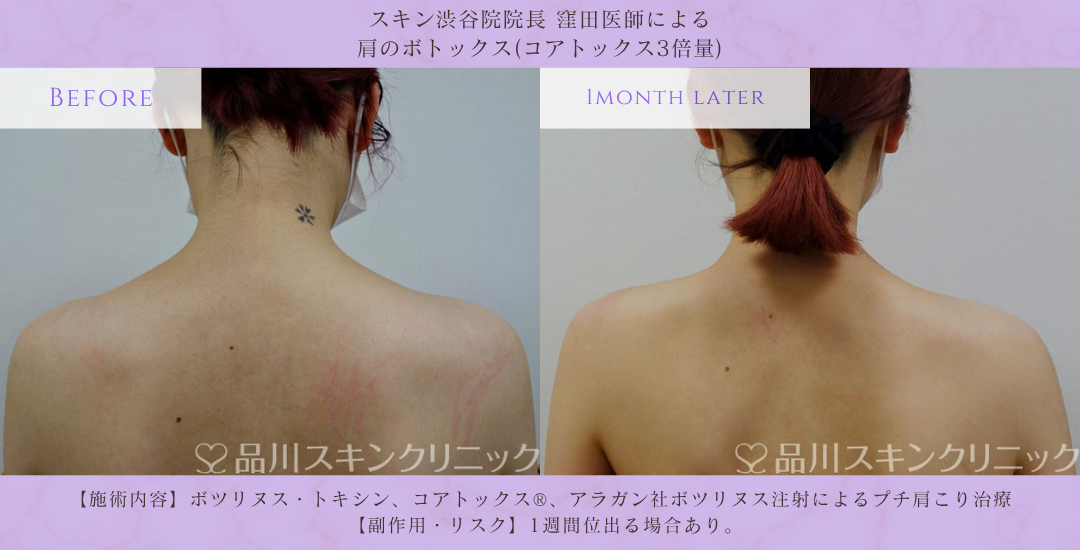 肩ボトックス 肩こり改善 症例