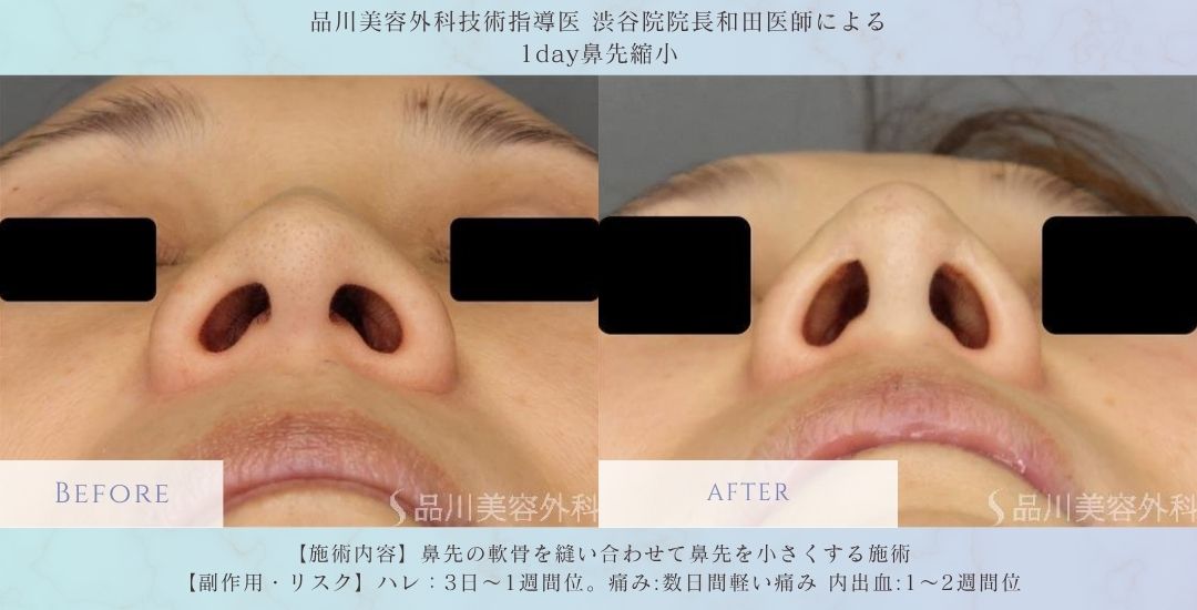 alt="1day鼻先縮小 ナチュラルな仕上がり 症例"