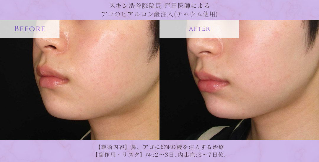 アゴヒアルロン酸 フェイスライン改善 症例