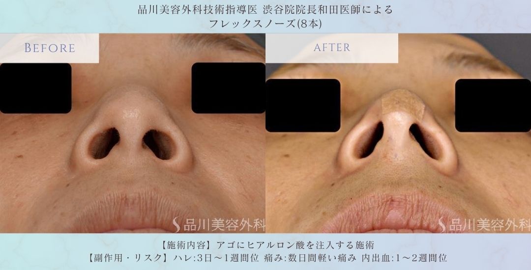 alt="鼻筋形成 フレックスノーズ 症例写真"
