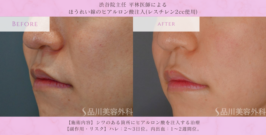 平林亮人医師 ほうれい線ヒアルロン酸 症例