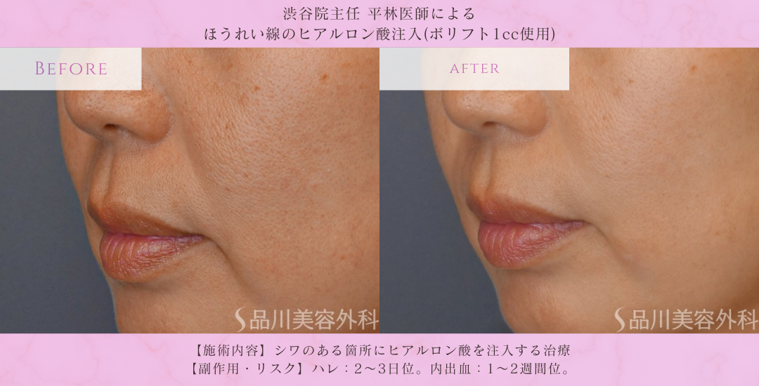 口元のシワ ヒアルロン酸治療 症例写真
