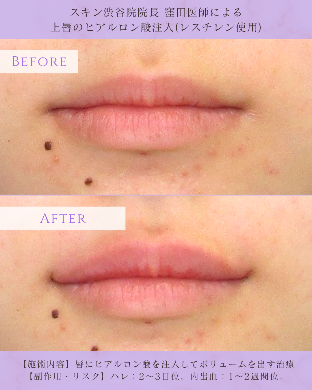 リップヒアルロン酸 ビフォーアフター