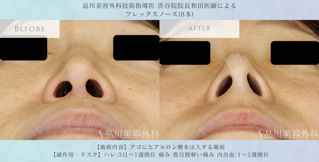 alt="切開を伴わない鼻整形 フレックスノーズ 症例"