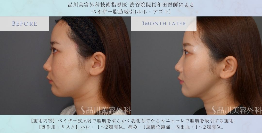 顔の脂肪吸引 東京 症例写真