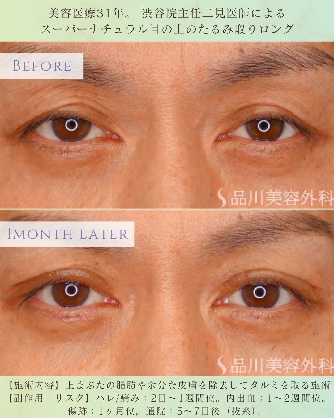 上眼瞼たるみ取り 症例写真 40代女性