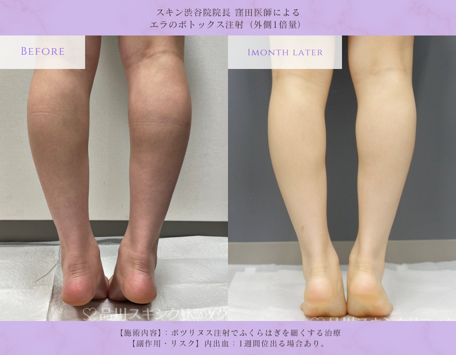 ふくらはぎボトックス 症例写真 品川スキンクリニック渋谷院